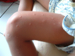 Mosquito bits